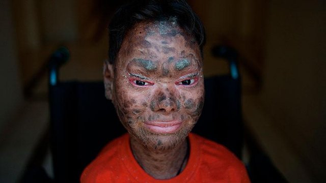 El extraño caso de la ‘nena serpiente’ que conmueve al mundo